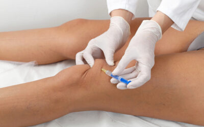 How Long Does a Knee Injection for Arthritis Last?