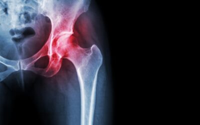 Hip Osteoarthritis: What are Your Treatment Options?